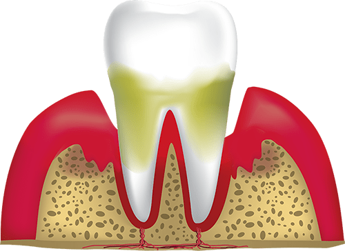 advanced periodontitis