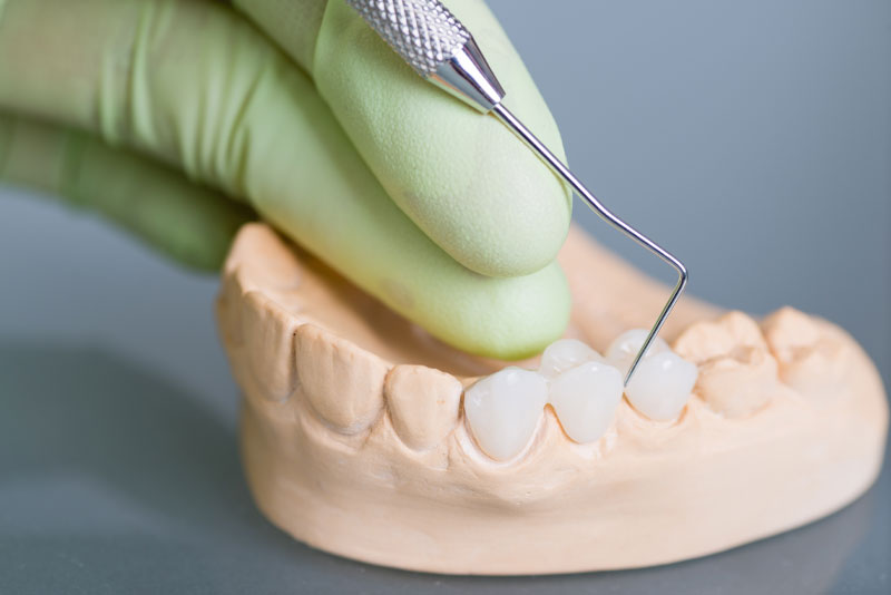 dental bridge model