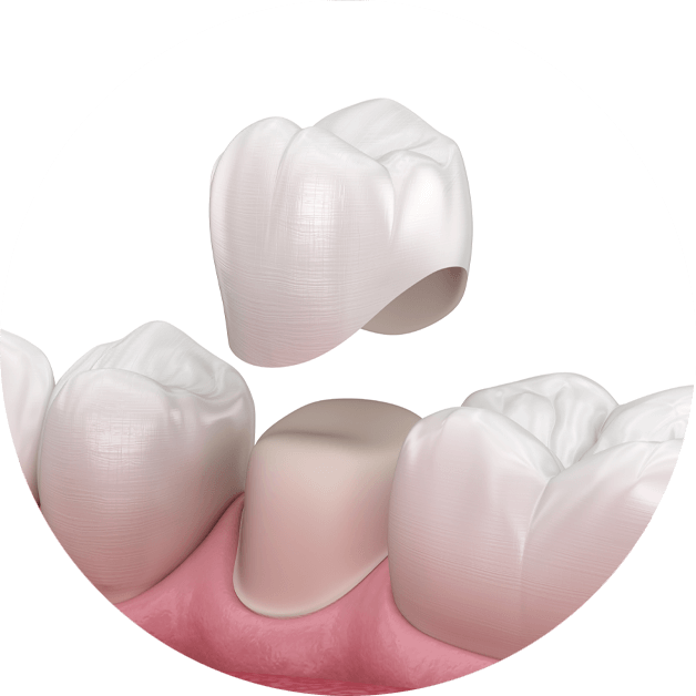 dental crowns model