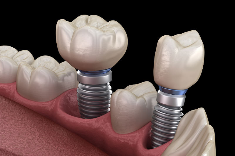 dental implants model