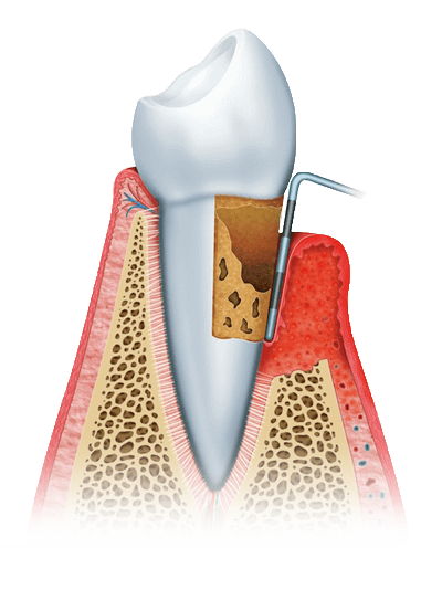 advanced periodontitis graphic