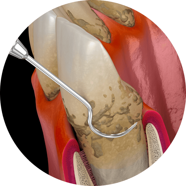 periodontal deep cleaning