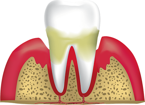periodontitis