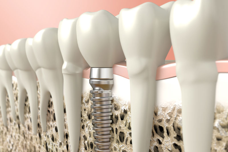 Dental Implants In Jawbone, Surrounded By Natural Teeth