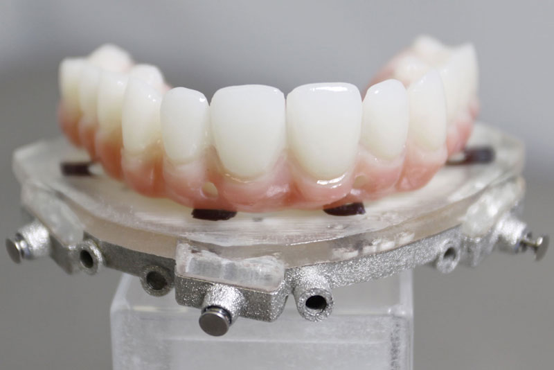 CHROME GuidedSmile Model, For Guided Implant Surgery