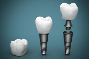 Dental Implant Models Together On A Blue Background