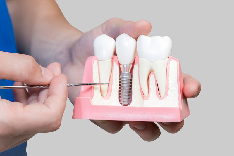 Dental Assistant Showing Off A Dental Implant In A Jawbone Cutaway Model in Cambridge, OH