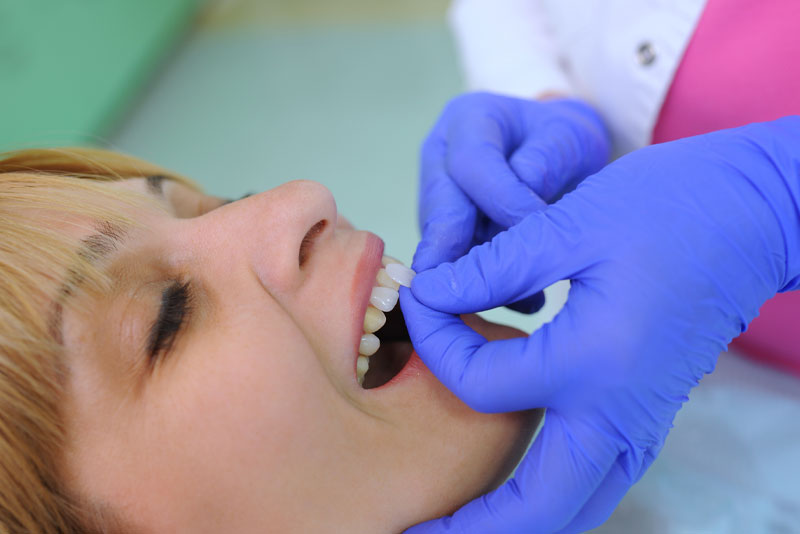 picture of a dentist placing dental veneers on a smiling patient.