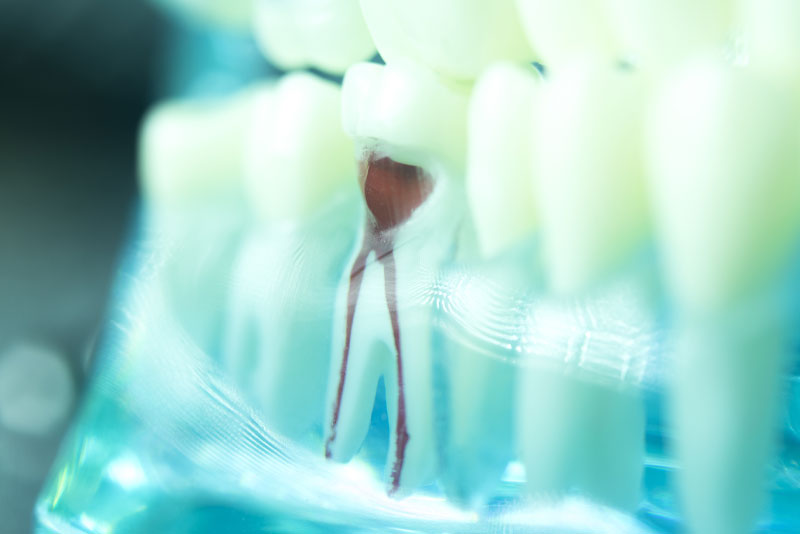 a dental root canal model