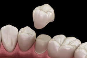 a model of a single dental crown being implanted