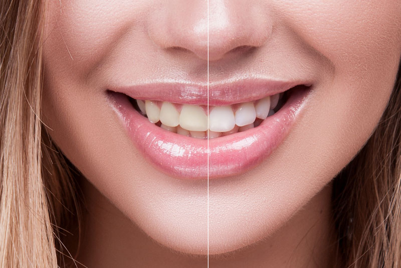 image of a woman's face divided in half to show the before and after affect of professional teeth whitening