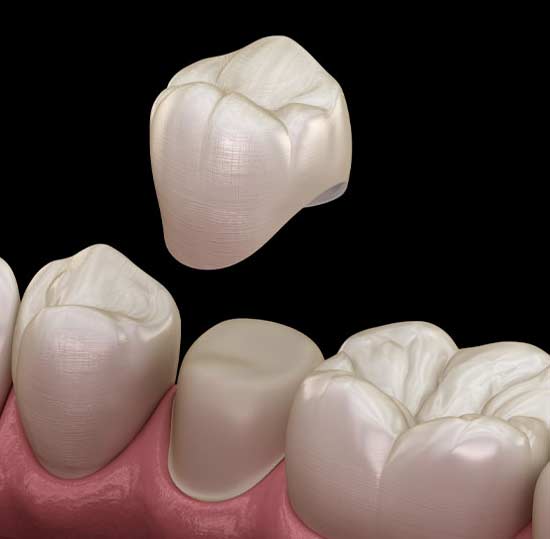 a model of a dental crown being placed