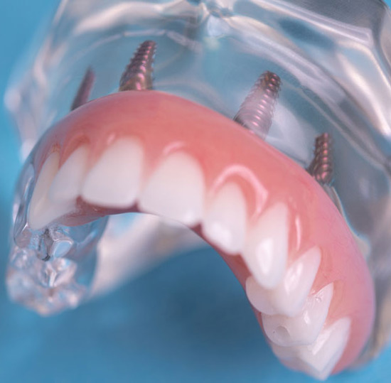 full arch dental implants