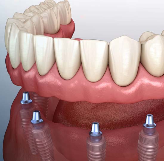 implant supported dentures