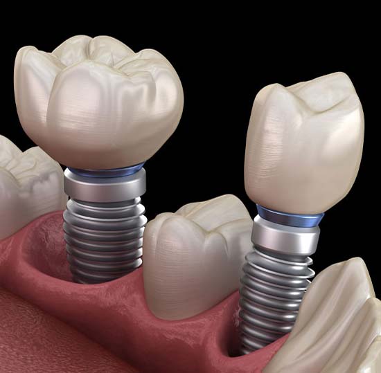 two dental implants being placed