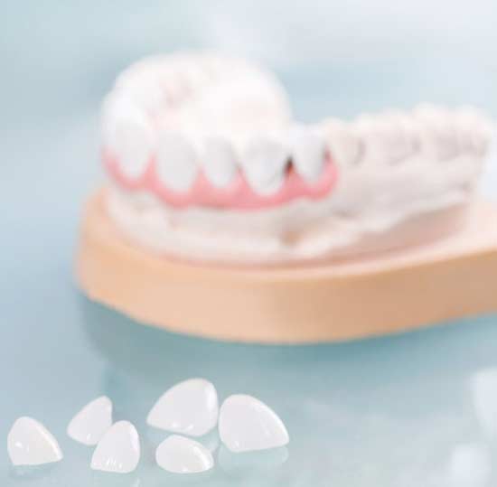 porcelain veneers next to a model of teeth