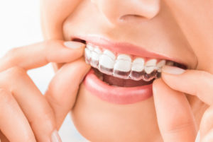 a patient happily placing Invisalign clear aligners on her teeth.