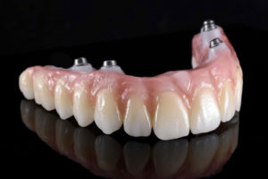 an image of a zirconia fixed bridge that shows how it can benefit patients with four dental implants placed in them.