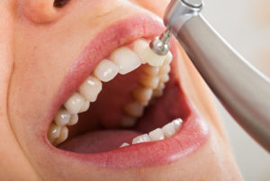 a close up picture of a patient getting her upper arch of teeth professionally cleaned during a teeth cleaning procedure.