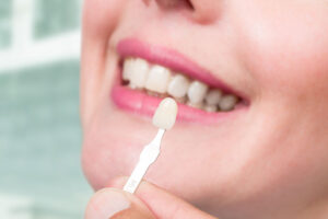a dental veneers patient getting color matched for the smile.