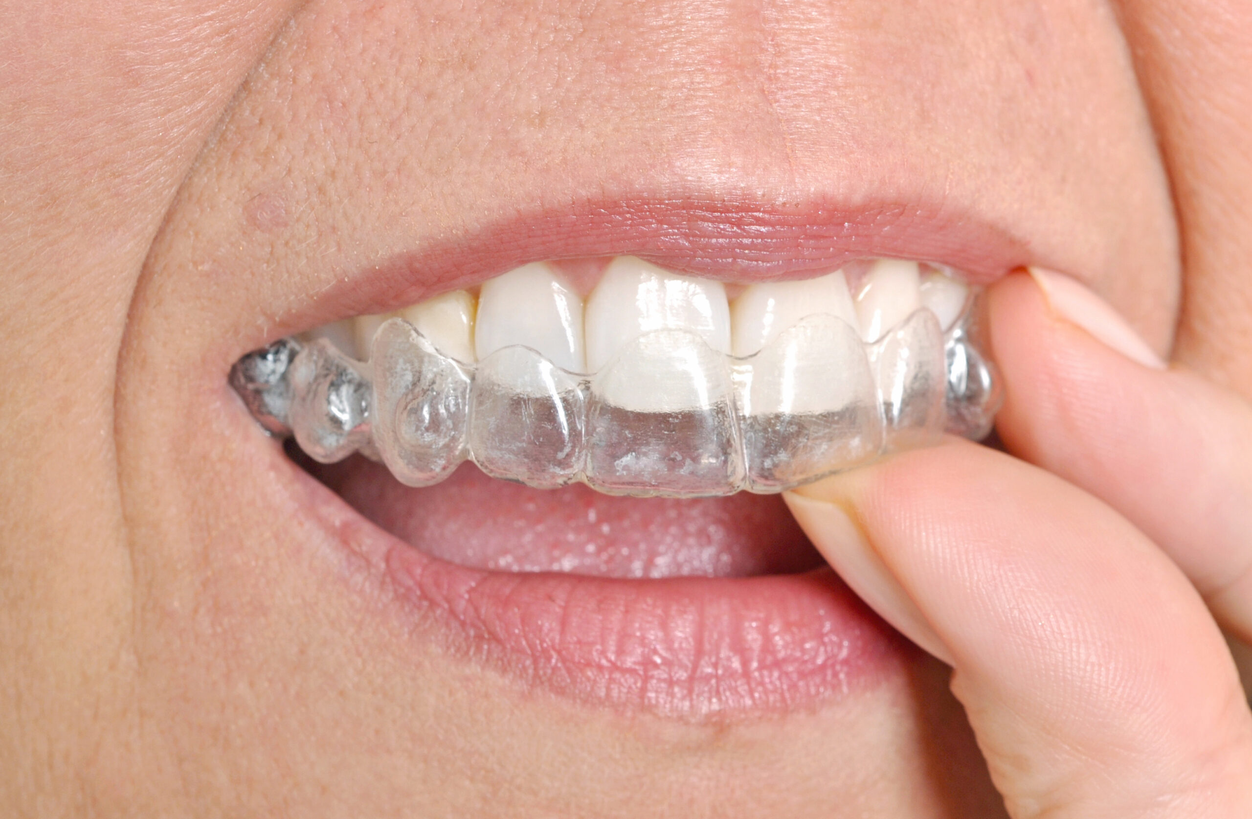 an image of invisalign example with a woman placing invasalign aligners in her mouth.