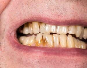 Close up macro of teeth of patient with receding gums and bad plaque on uneven teeth prior to cleaning and root planing.
