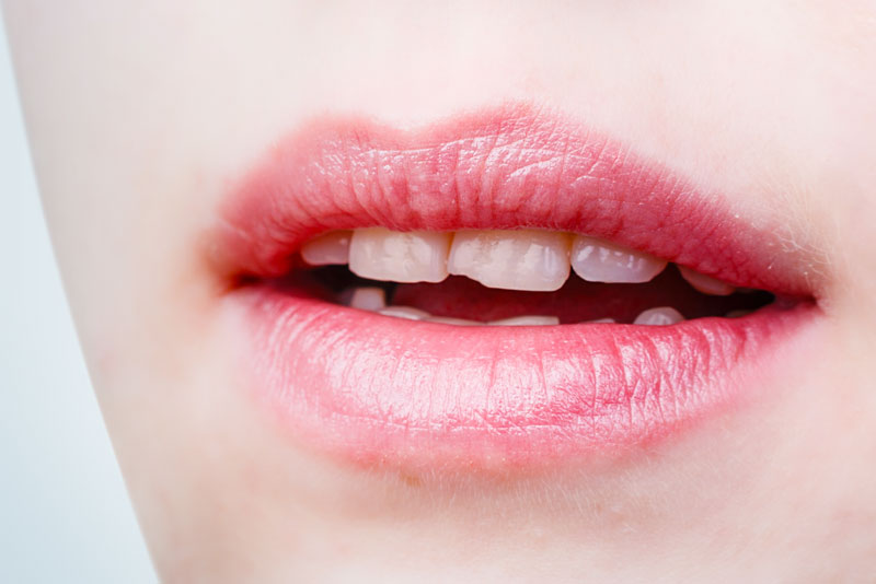 a persons slightly opened mouth, showing the imperfect looking teeth that need to be aesthetically enhanced with porcelain veneers.