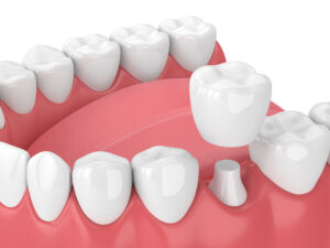 3d render of jaw with teeth and dental crown restoration over white background.