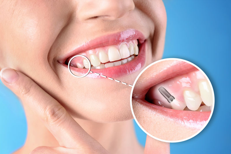 Photo of a doctor holding and working on a clear jaw prosthesis with an implant in it