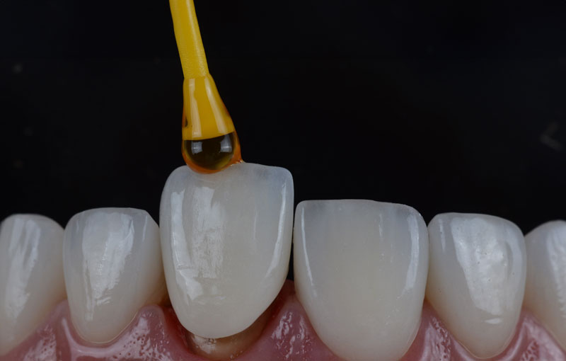The image shows a close-up view of dental veneers being applied to teeth. A drop of adhesive is placed on a veneer, which is positioned on a tooth.