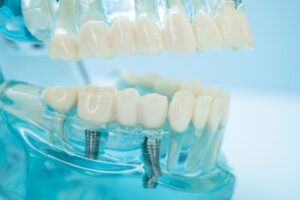 full mouth dental implants, dental implants in mouth model, implant solutions