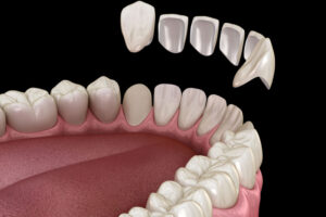 3D illustration showing the placement of porcelain veneers on upper front teeth, with one veneer positioned in front of a prepared tooth, demonstrating a cosmetic dental procedure for smile enhancement.