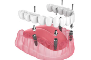 3D illustration of a full arch dental implant system showing multiple implants placed in the jawbone with a fixed denture secured on top.