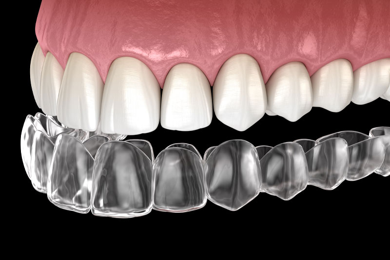 3D illustration of clear aligners being placed over upper teeth, showing how Invisalign fits snugly to straighten teeth discreetly.