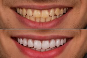 A before-and-after photo showcasing a patient's smile transformation with porcelain veneers, highlighting improved alignment and whiter teeth. No text on image.